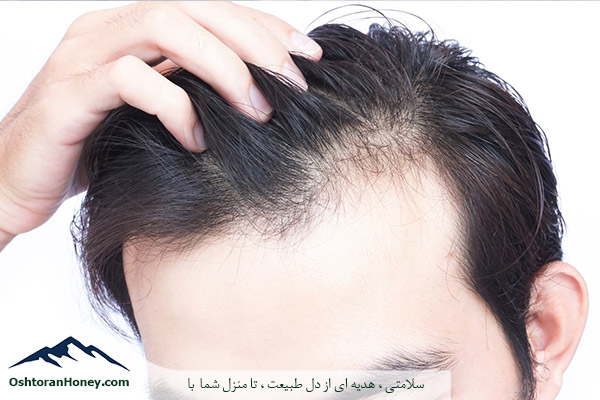 درمان خانگی ریزش مو با ژل رویال